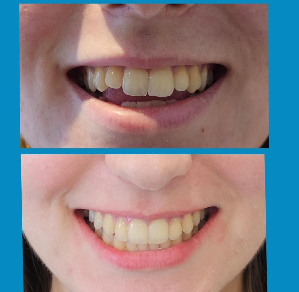 Invisalign before and after at Avondale Dental Clinic Bray — Gaps closed, even smile line