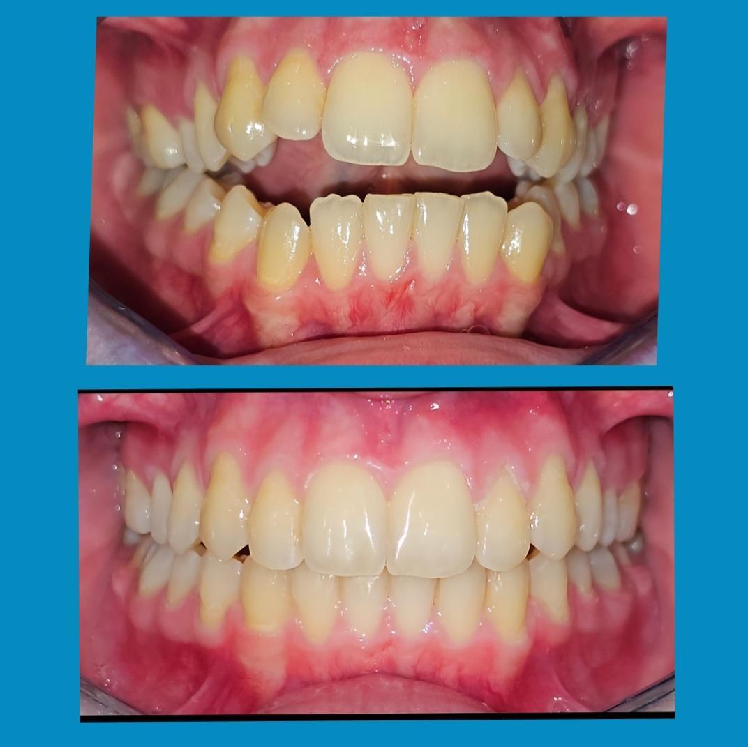 Invisalign before and after at Avondale Dental Clinic Bray — Open bite closed