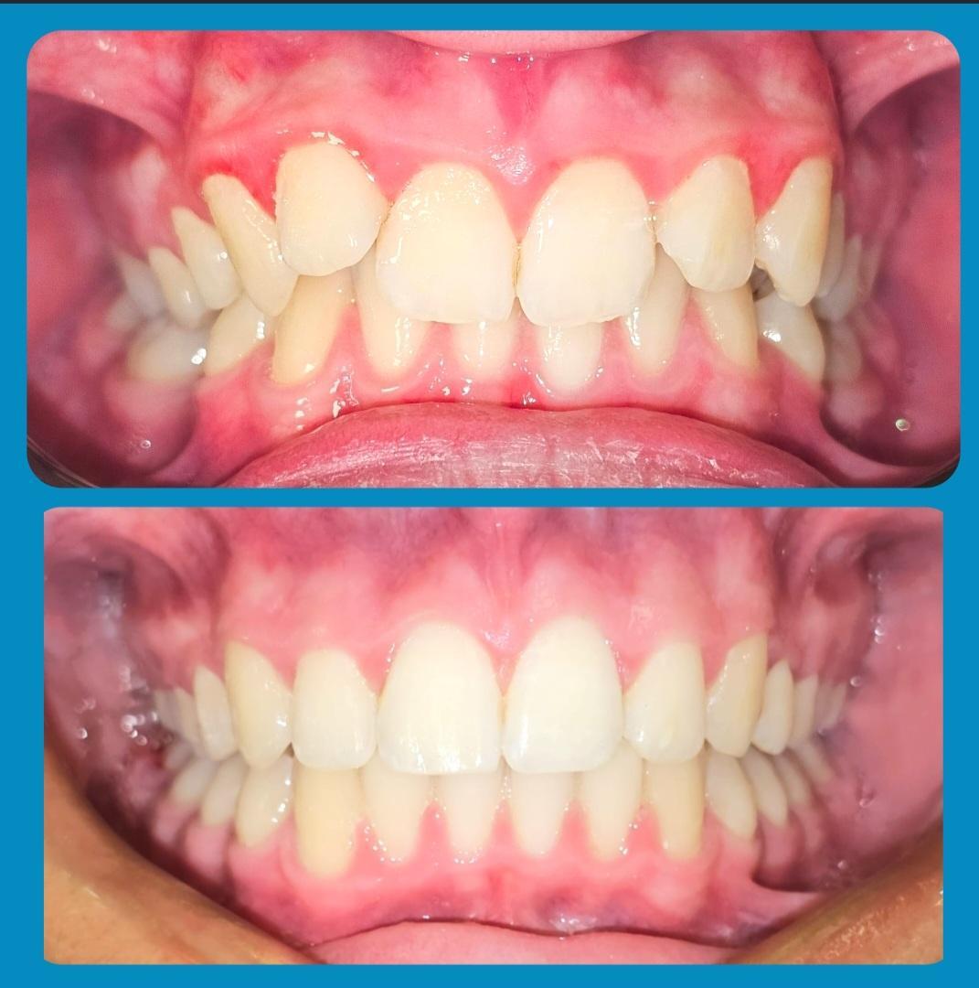 Invisalign before and after at Avondale Dental Clinic Bray — Crowding & overlapping front teeth