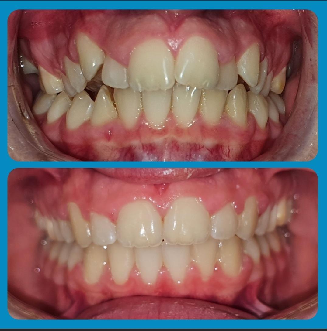 Invisalign before and after at Avondale Dental Clinic Bray — Crowding & crooked lower teeth