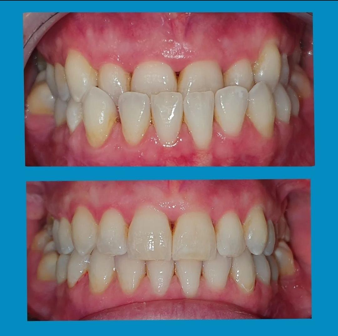 Invisalign before and after at Avondale Dental Clinic Bray — Uneven, rotated teeth aligned